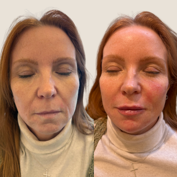 Before and after result