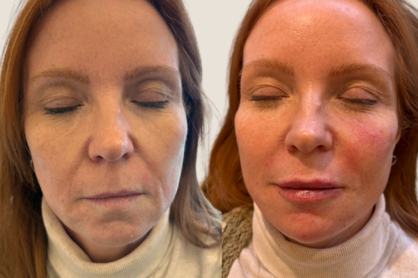 “I Feel Like My Face Has Suddenly Aged” – Where Do You Start With Aesthetic Treatments?