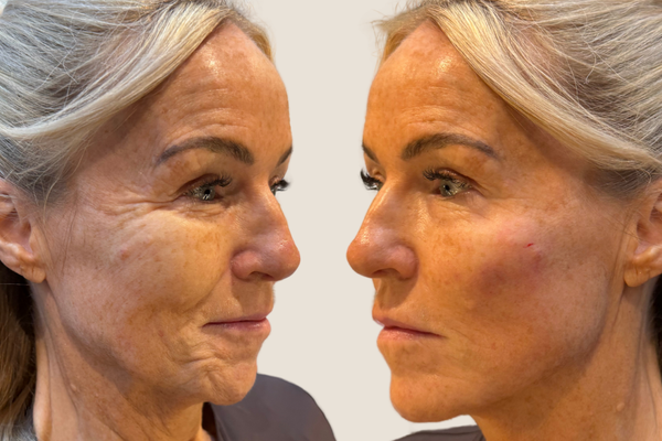 What Is Facial Balancing? Why I Assess the Whole Face Before Touching Any of It