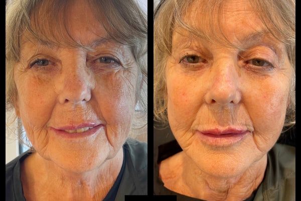 Reclaim Your Youth, With A Full Face Rejuvenation.