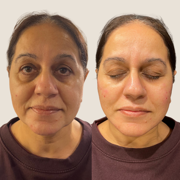 Before and after result