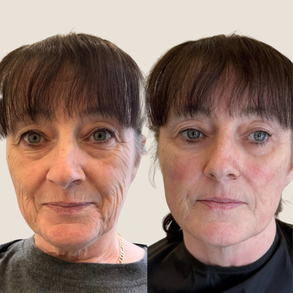 Before and after result