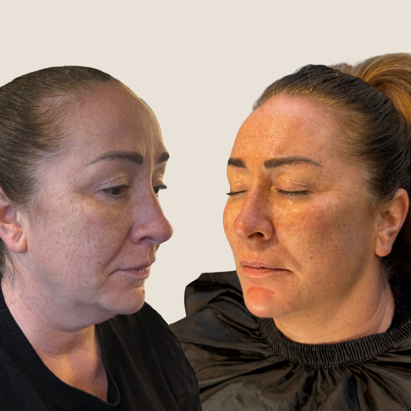 Before and after result